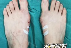 拇外翻手术过程视频,专业解析与康复指导