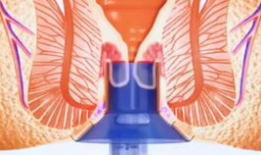 痔疮手术视频,直观了解手术步骤与细节